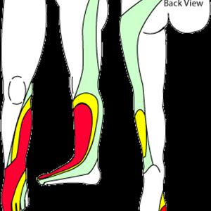 Sacro Sciatic Syndrome - The Miracle 10 - How Can You Help Your Sciatica?