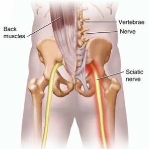 What Is Sciatic Area - Sciatica Pain Relief