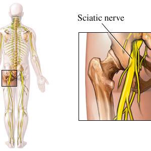 Drugs For Sciatica - What Is Sciatica