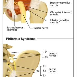 Sciatica Treatment Chiropractic - Is Discectomy Spine Surgery Right For My Sciatica?