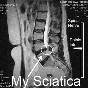 Sciatica Radiculopathy - Relief From Sciatica Back Pain