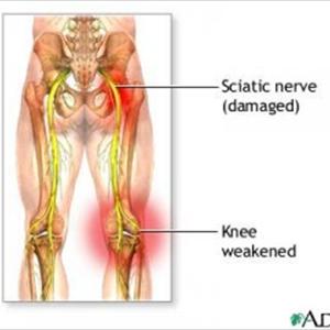 Sciatic Nerve Neuropathy Advice - Sciatica Or Piriformis Syndrome - Which Is It?