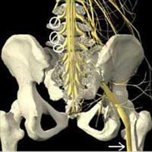 Sciatic Nerve Pain Relief - Sciatica Pain Relief ? Natural Lower Back Pain Relief