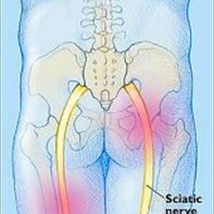 Sciatigon For Sciatica - Does Sciatica Scare You? Do You Need To Be Scared, Find Out Here...