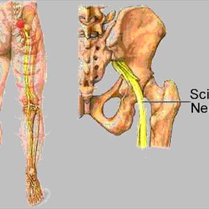 Sciatic Nerve Numbness - What Is Sciatica
